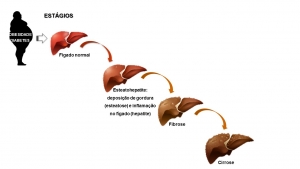 "Gordura no f&iacute;gado": qual o melhor tratamento?