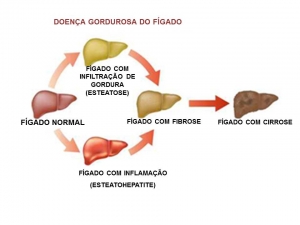 Doen&ccedil;a Hep&aacute;tica Gordurosa N&atilde;o Alco&oacute;lica - O que &eacute;?
