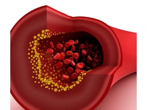 Dislipidemia na inf&acirc;ncia